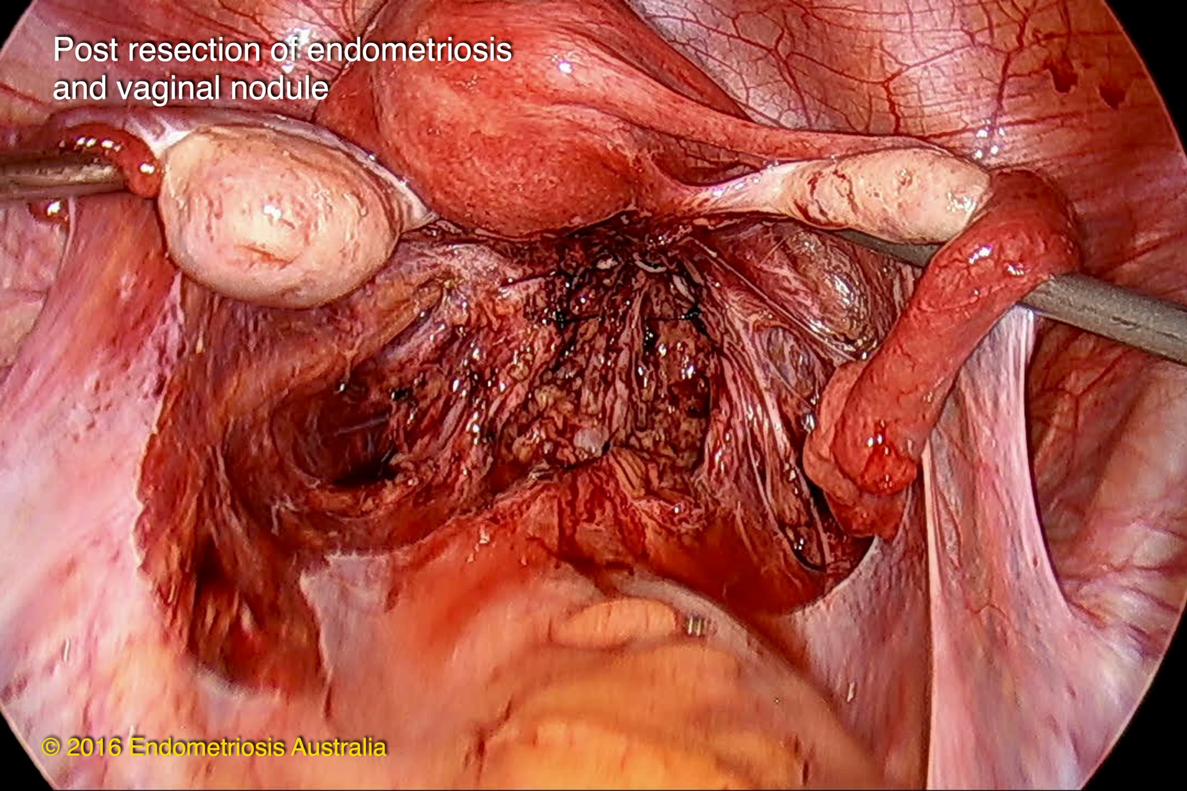 Post resection of endometriosis and vaginal nodule